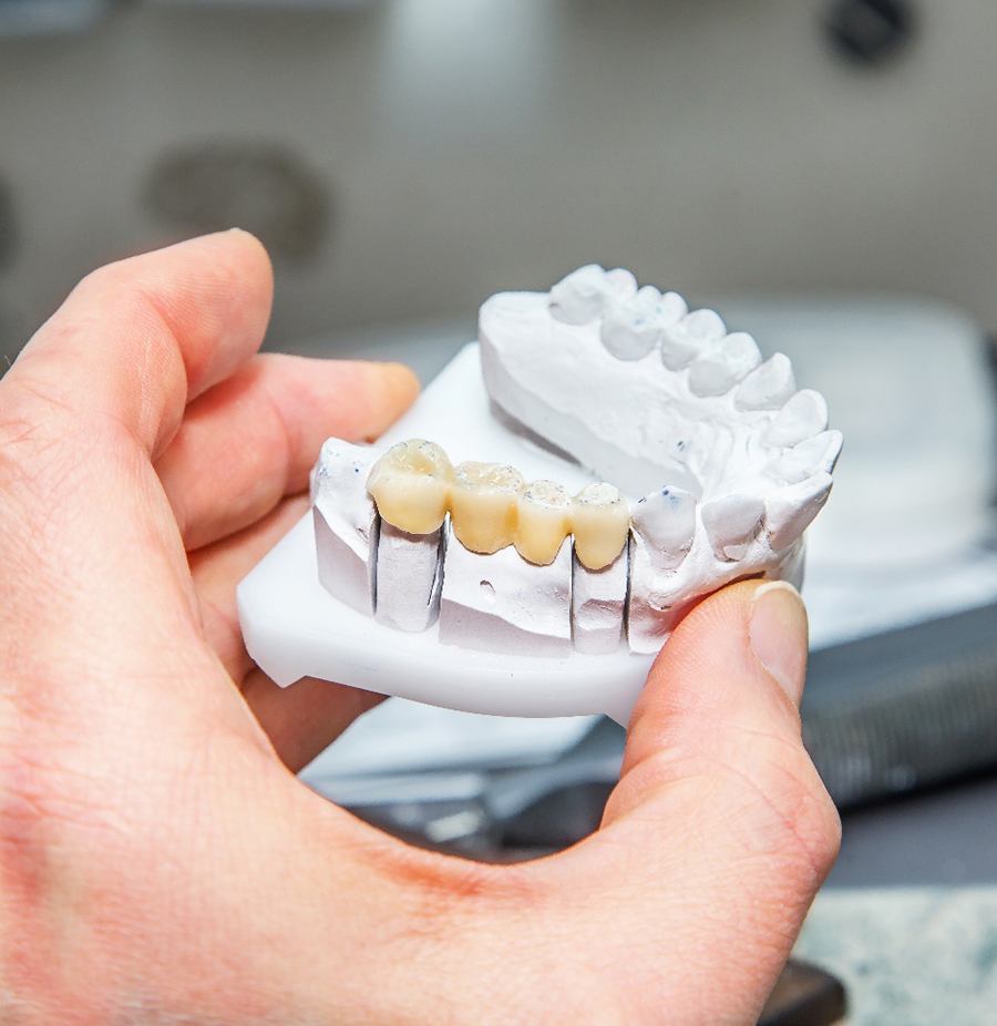 Hand holding model with a dental bridge