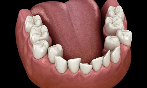 Illustration of crowded teeth