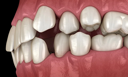 Illustration of gapped teeth