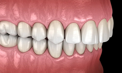 Illustration of an overbite