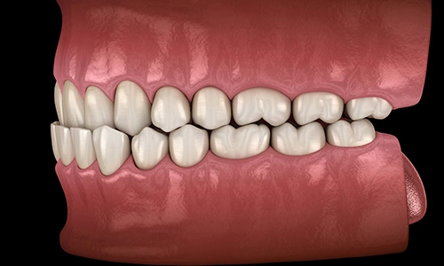 Illustration of an underbite