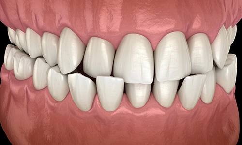 Illustration of a crossbite