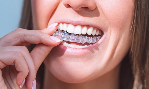 Close-up of woman placing clear aligner on her teeth
