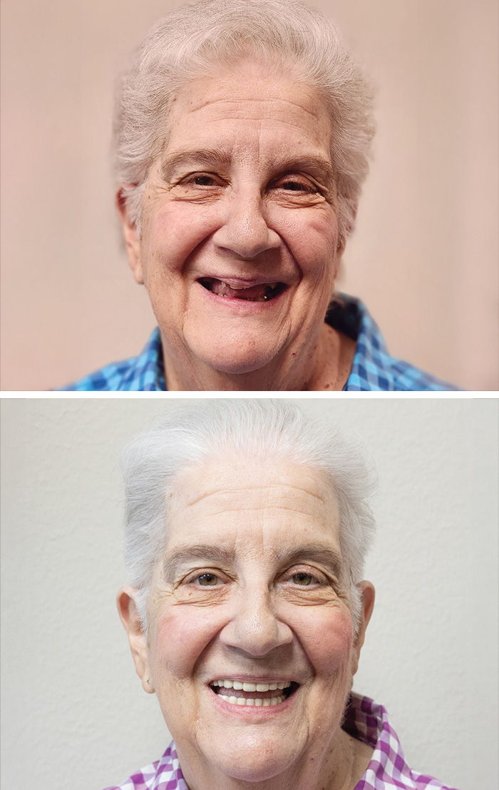 Close up of a mouth before and after replacing a missing upper front tooth with a dental implant