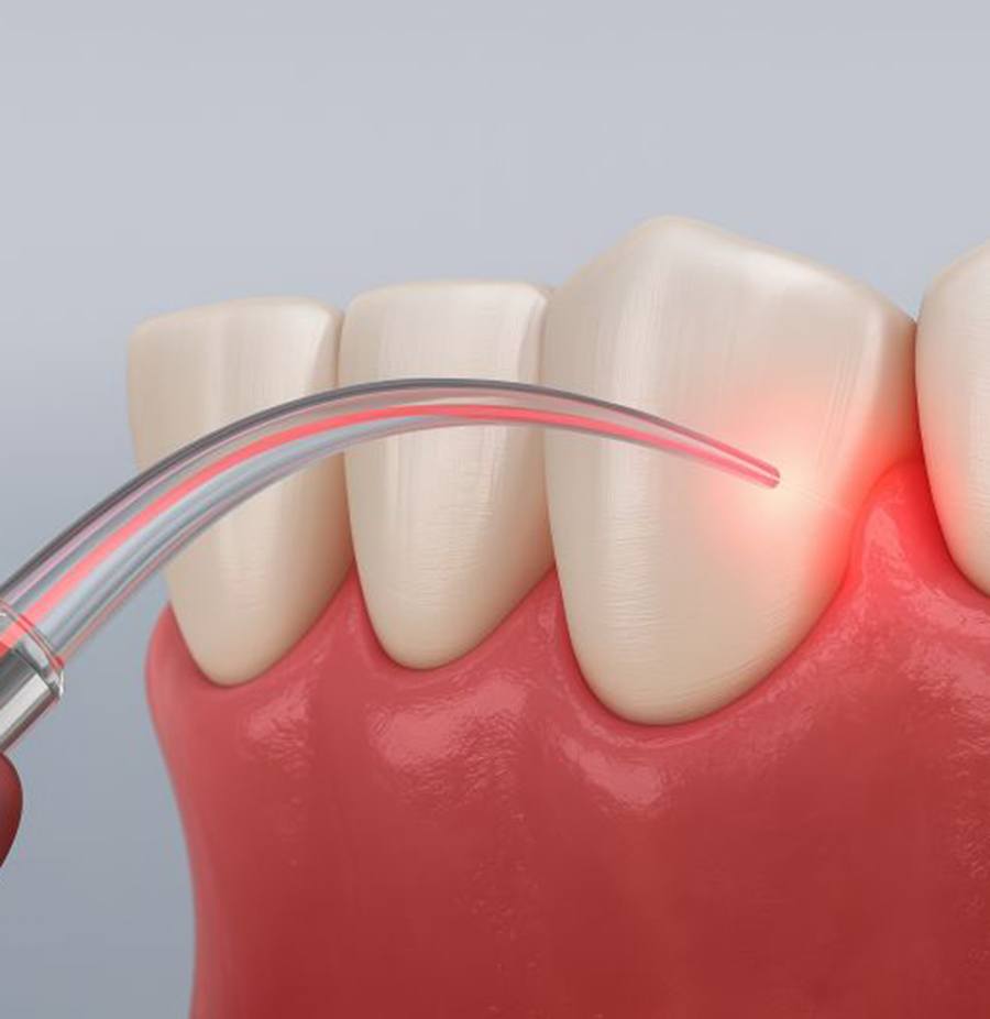 Illustration of dental laser being used on gums