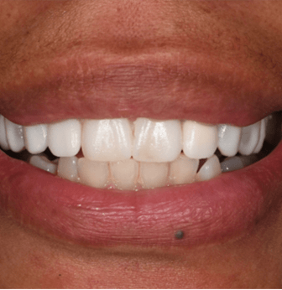 Close-up of patient’s smile before and after gum recontouring