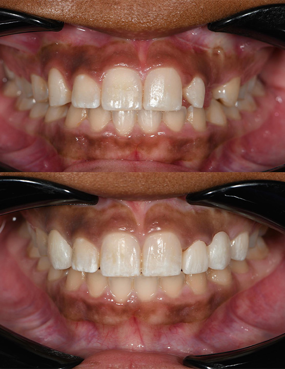 Veneer and Bridge before