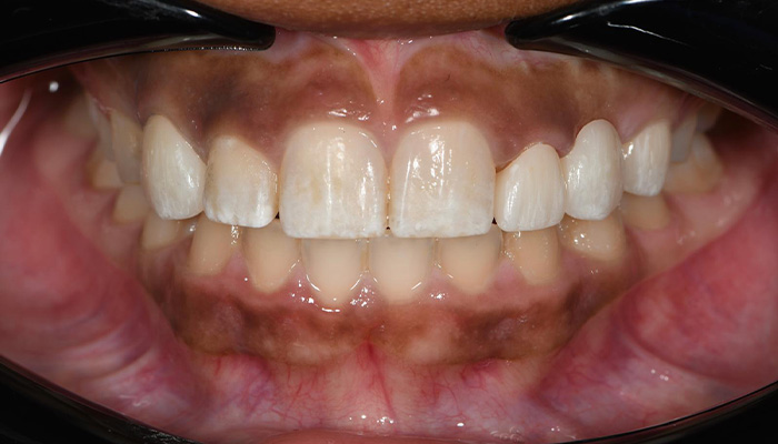 Veneer and Bridge after