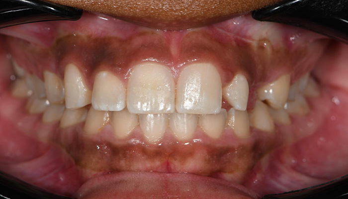 Veneer and Bridge before