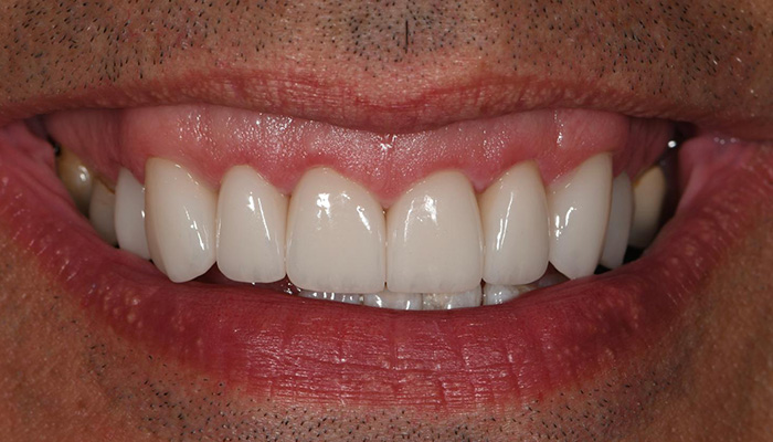 Close up of a mouth with a full set 