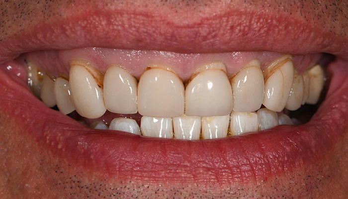 Close up of a mouth with damaged teeth