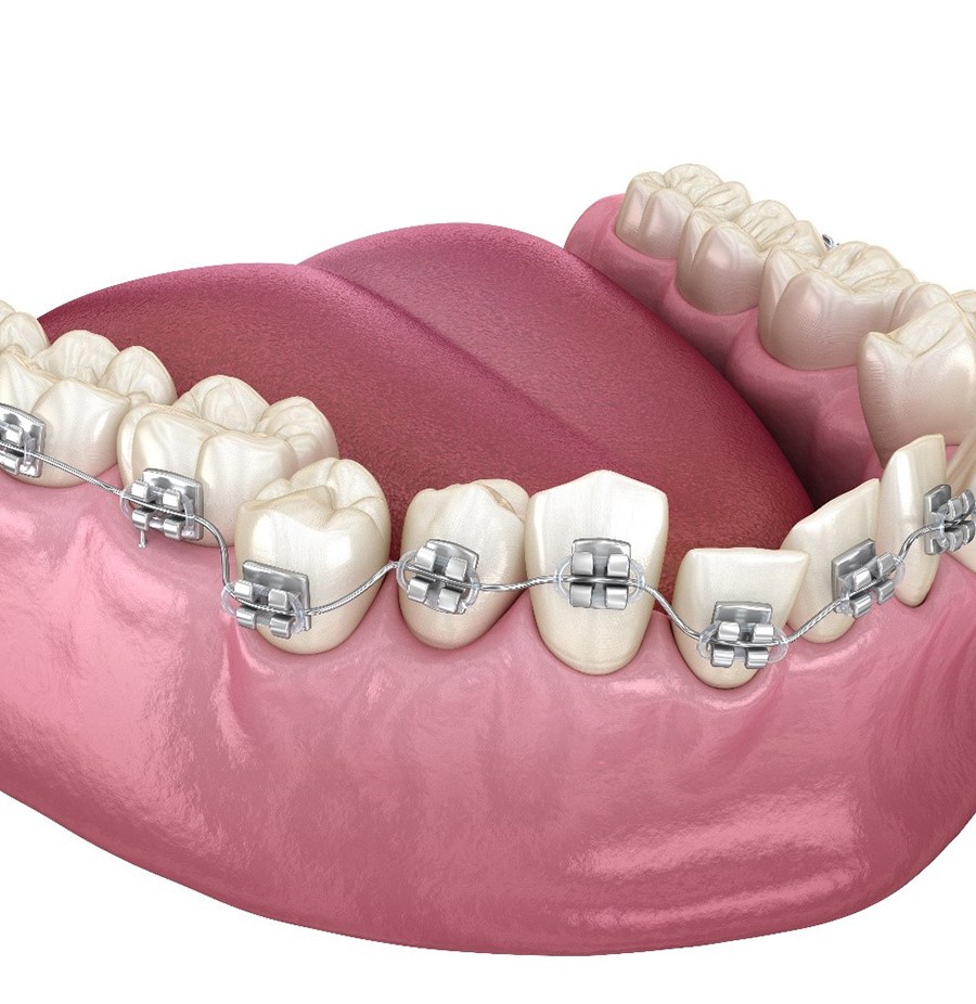 Illustration of crooked teeth with metal braces