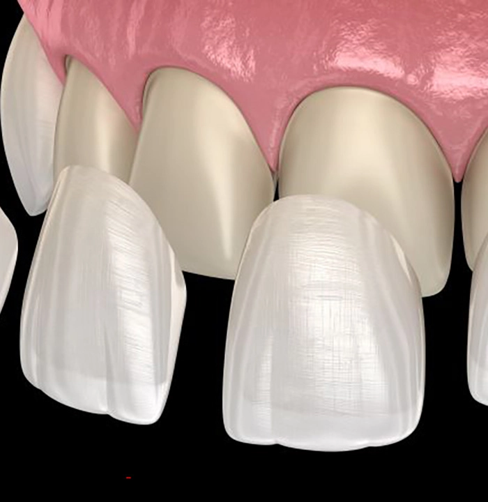 Illustration of veneers being placed on front teeth