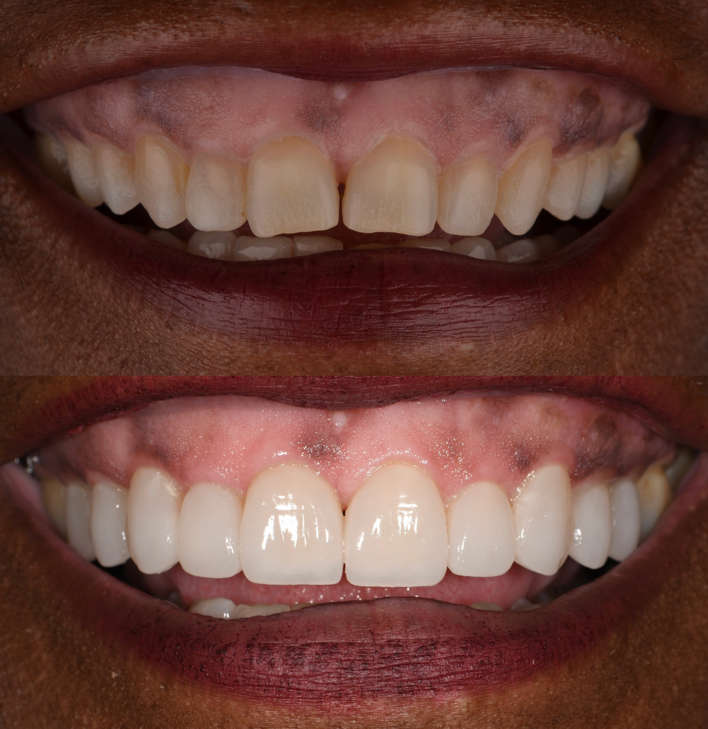 Confident woman with veneers relaxing on the beach